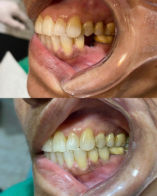 Casos-Antes-e-Depoi2